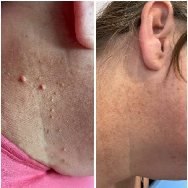NovaDerm™