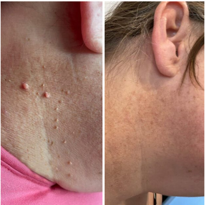 NovaDerm™